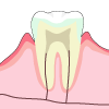 歯の構造のイラスト
